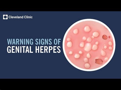 Genital Herpes on Shaft: Symptoms, Diagnosis,。